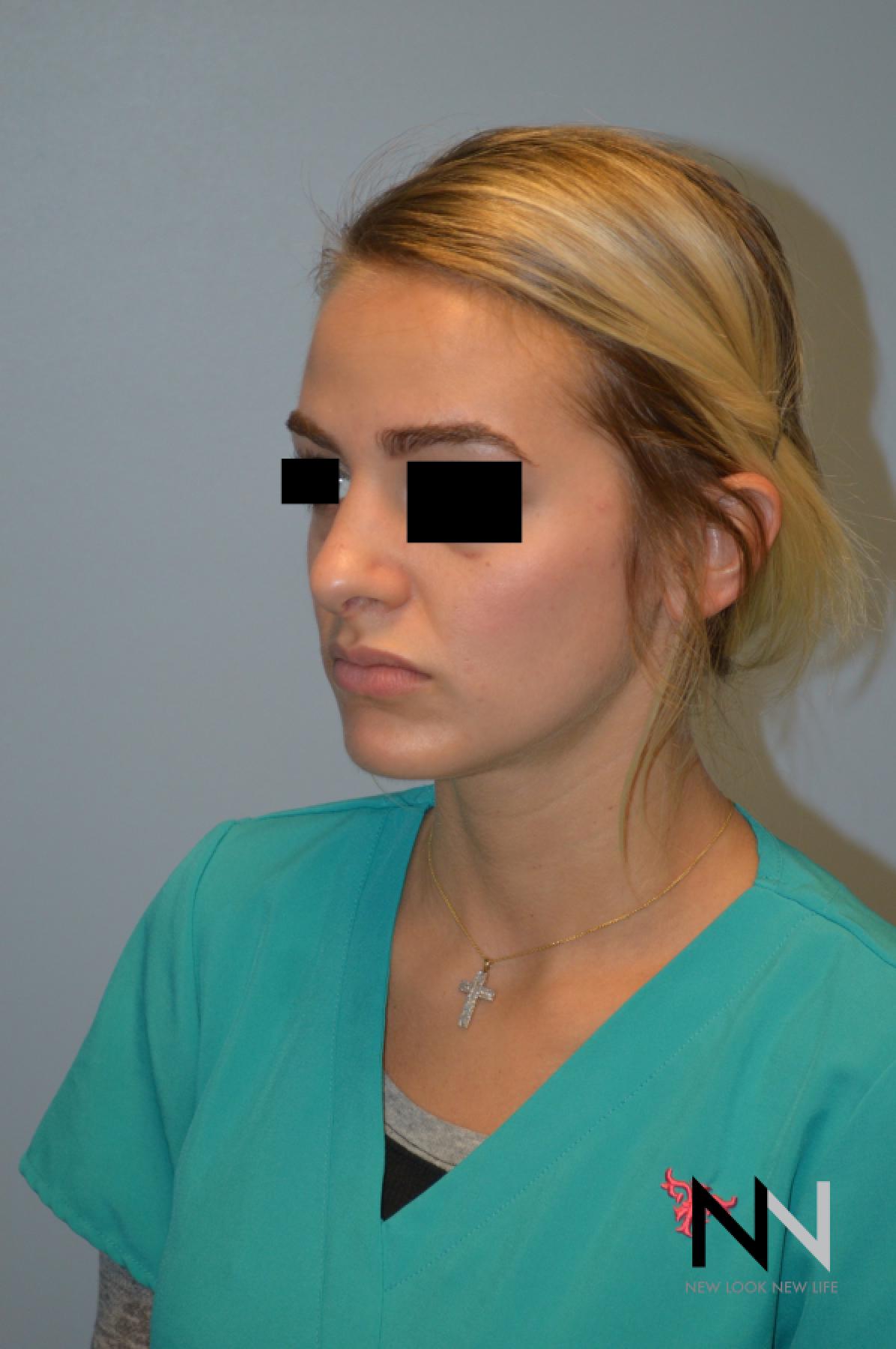 Rhinoplasty: Patient 3 - After 2