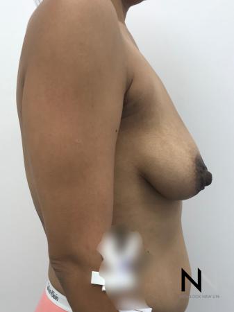 Breast Lift: Patient 1 - Before Image 4