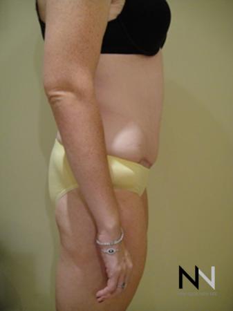 Abdominoplasty: Patient 2 - After Image 3
