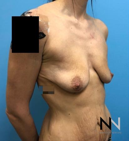 Breast Lift: Patient 18 - Before and After Image 2