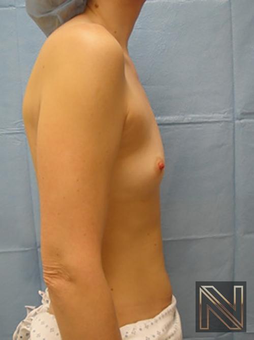 Breast Augmentation: Patient 5 - Before and After 5