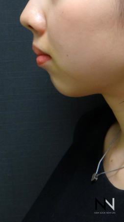 Chin Augmentation: Patient 2 - Before Image 1