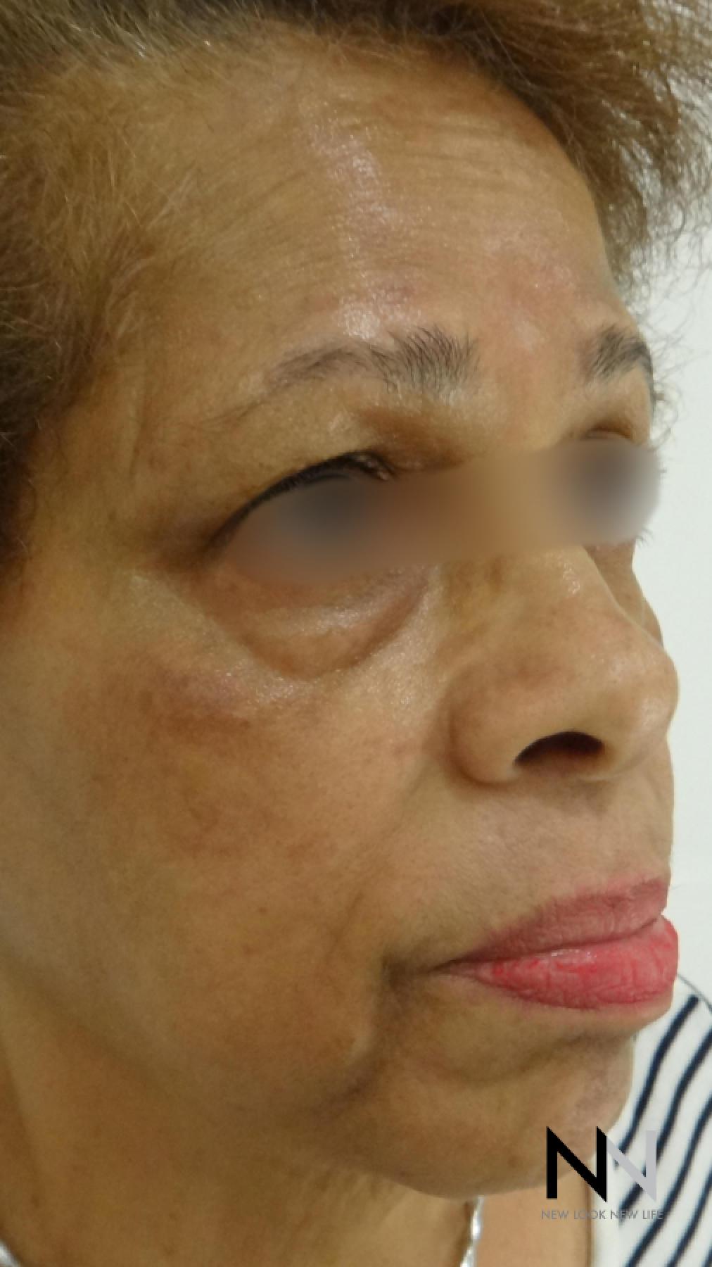 Laser Skin Resurfacing - Face: Patient 2 - Before and After 3