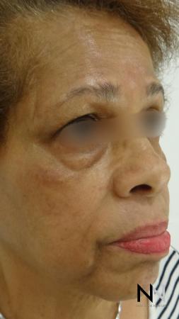 Laser Skin Resurfacing - Face: Patient 2 - Before and After 3