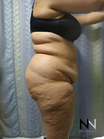 Abdominoplasty: Patient 14 - Before and After Image 3