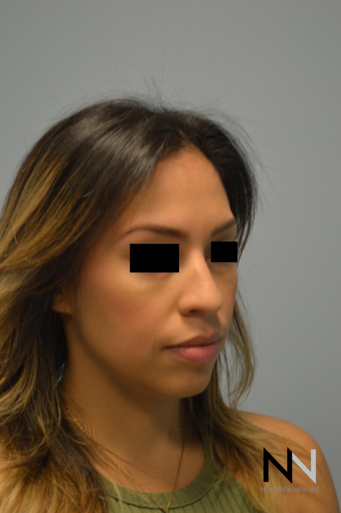 Rhinoplasty: Patient 6 - Before and After 5