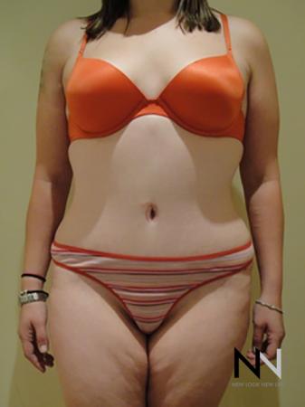 Abdominoplasty: Patient 5 - After Image 1