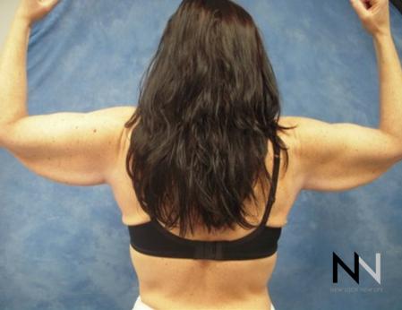 Brachioplasty: Patient 2 - Before and After Image 2