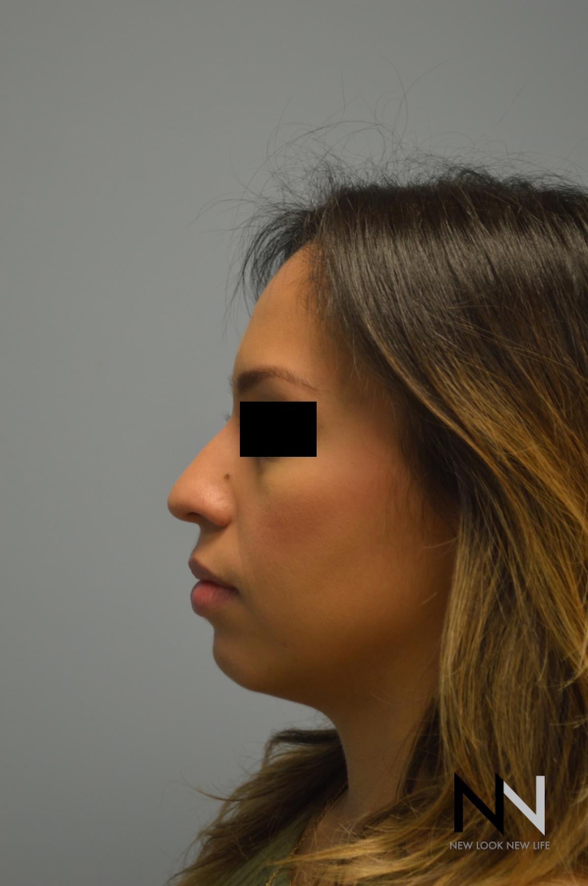 Rhinoplasty: Patient 6 - Before 2