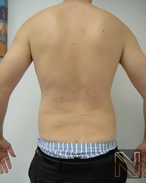 Liposuction: Patient 18 - After 1