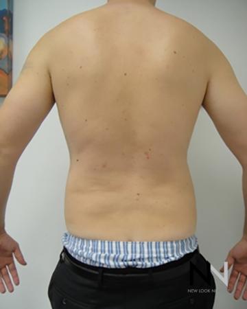 Liposuction: Patient 18 - After Image 1
