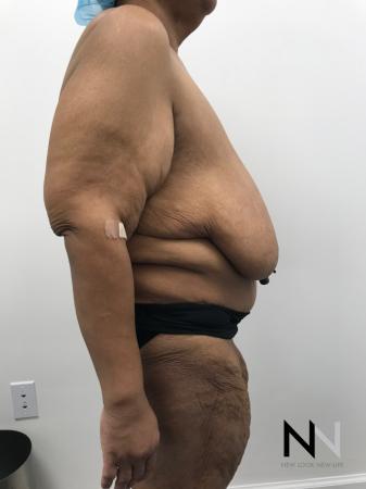 Breast Reduction: Patient 2 - Before Image 2
