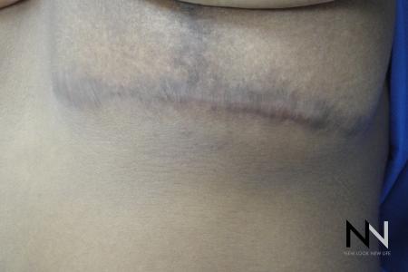 Fractional Resurfacing: Patient 9 - Before and After Image 2