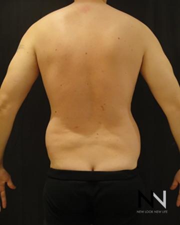Liposuction: Patient 18 - Before Image 1