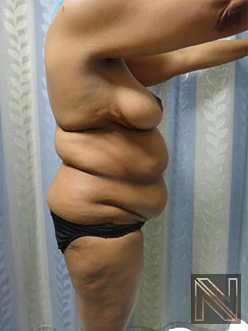 Abdominoplasty: Patient 8 - Before and After 3