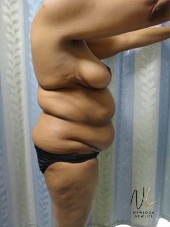 Abdominoplasty: Patient 8 - Before and After Image 3