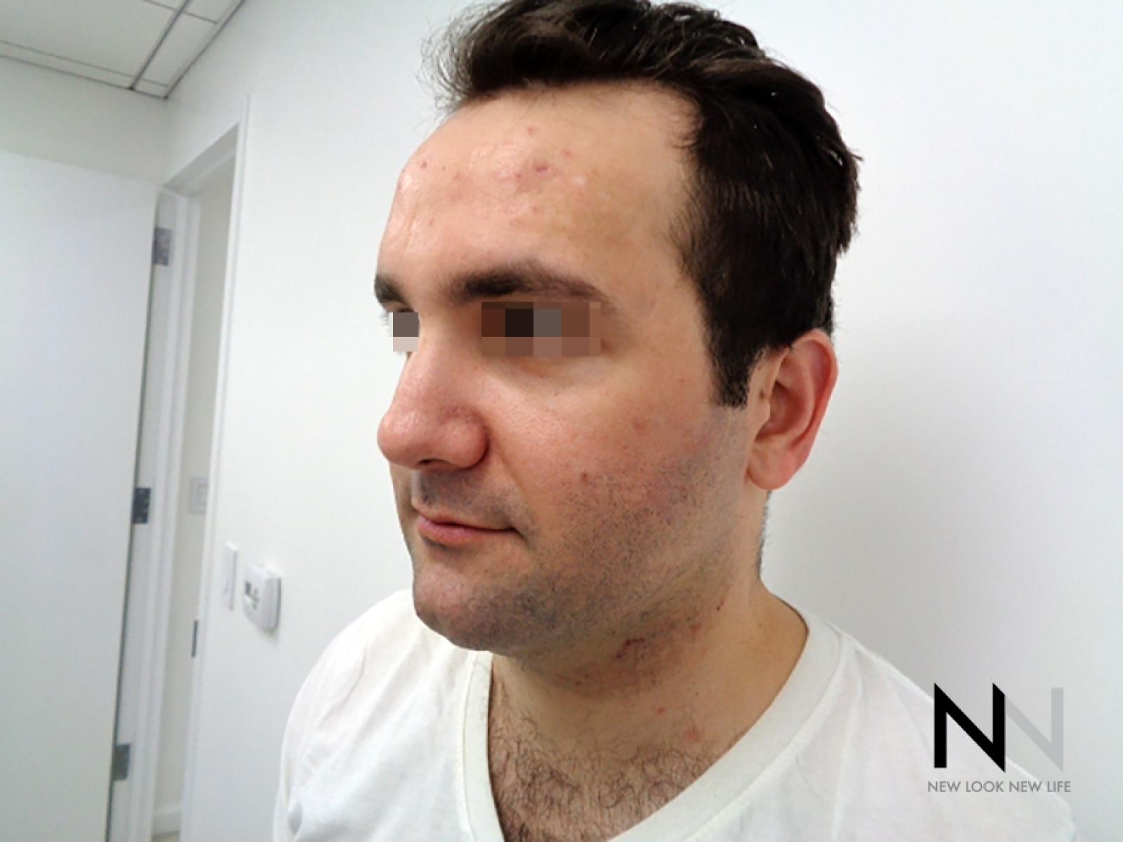 Laser Skin Resurfacing - Face: Patient 3 - Before 2