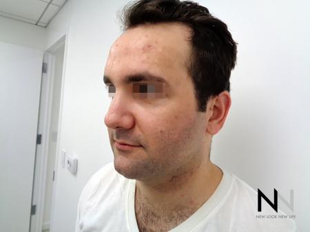Laser Skin Resurfacing - Face: Patient 3 - Before 2