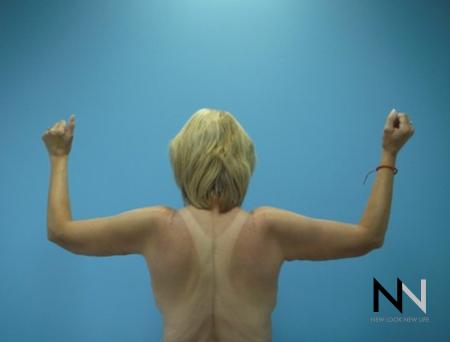 Brachioplasty: Patient 5 - After 1