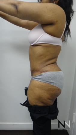 Abdominoplasty: Patient 23 - After 2