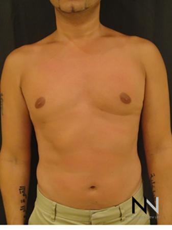 Gynecomastia: Patient 2 - After Image 1