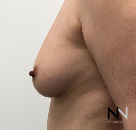 Fat Transfer - Body: Patient 2 - Before Image 4