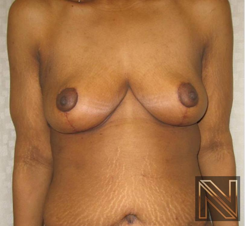 Breast Lift: Patient 13 - After 1