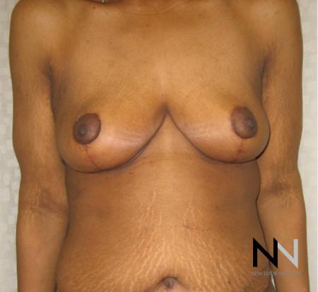 Breast Lift: Patient 13 - After Image 1