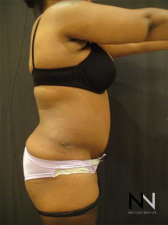 Abdominoplasty: Patient 10 - After 3