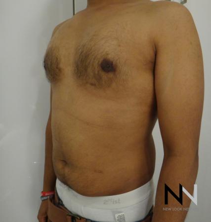 Gynecomastia: Patient 6 - After Image 2