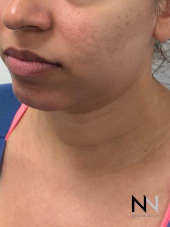 Liposuction: Patient 2 - Before Image 3