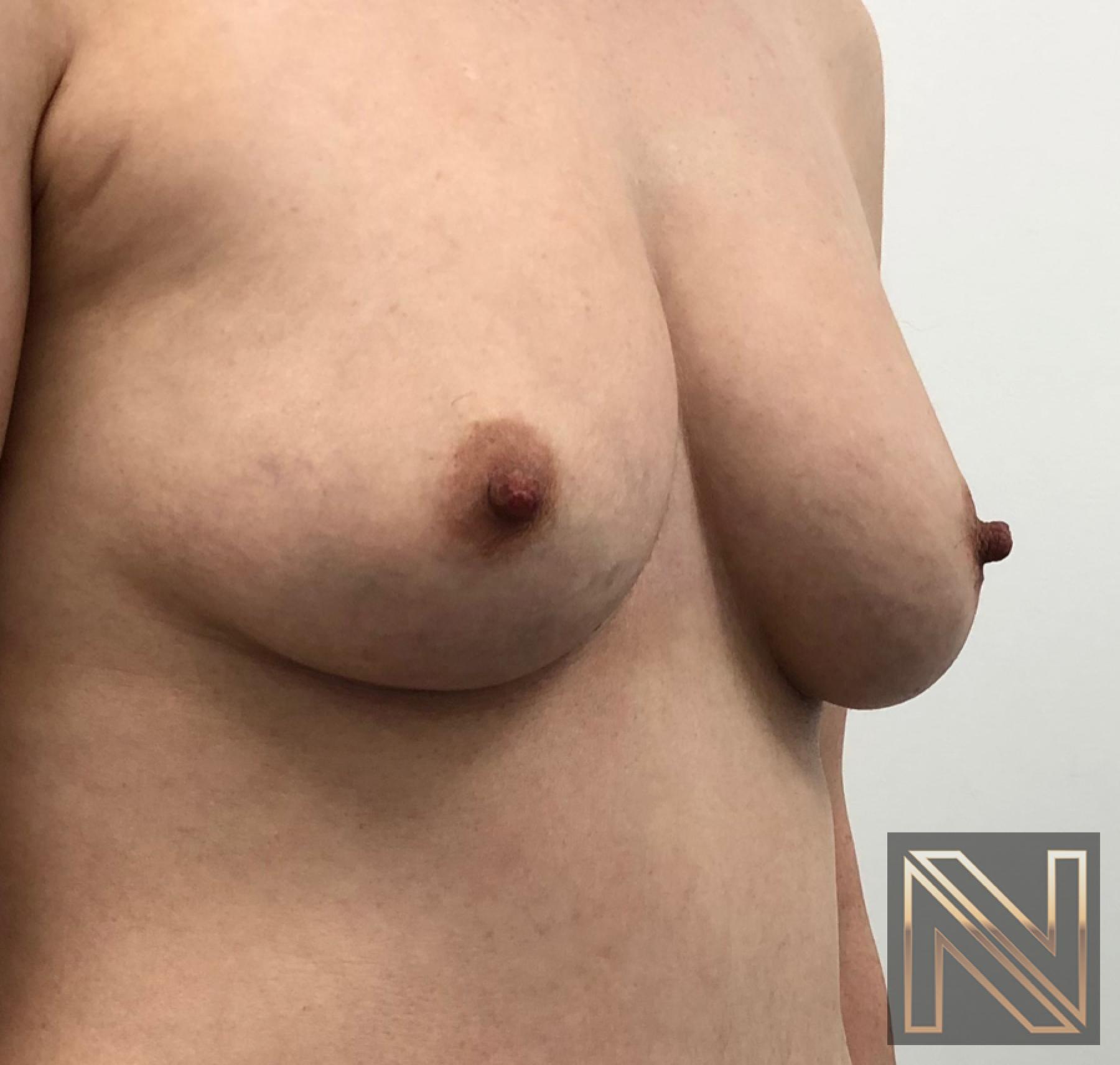 Fat Transfer - Body: Patient 2 - Before 