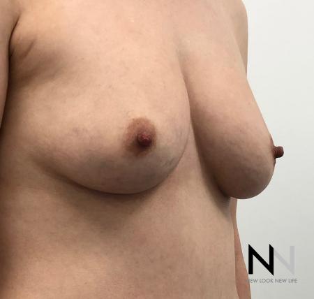 Fat Transfer - Body: Patient 2 - Before Image 1