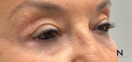 Fractional Resurfacing: Patient 7 - After Image 2