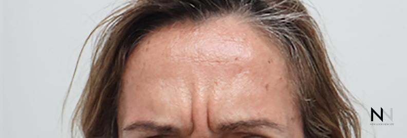 BOTOX® Cosmetic: Patient 6 - Before 