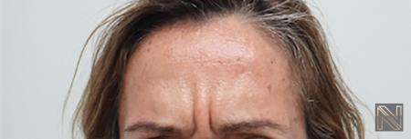 BOTOX® Cosmetic: Patient 6 - Before 
