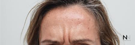 BOTOX® Cosmetic: Patient 6 - Before Image 1