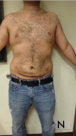 Liposuction: Patient 16 - After Image 1