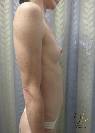 Breast Augmentation: Patient 17 - Before Image 4