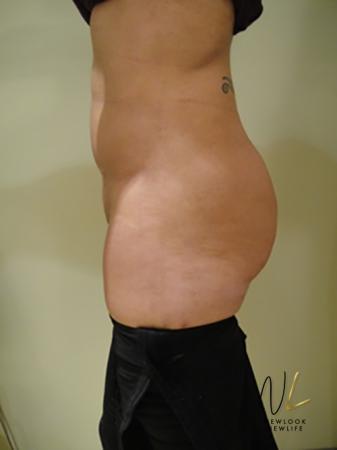 Butt Augmentation: Patient 1 - After Image 1