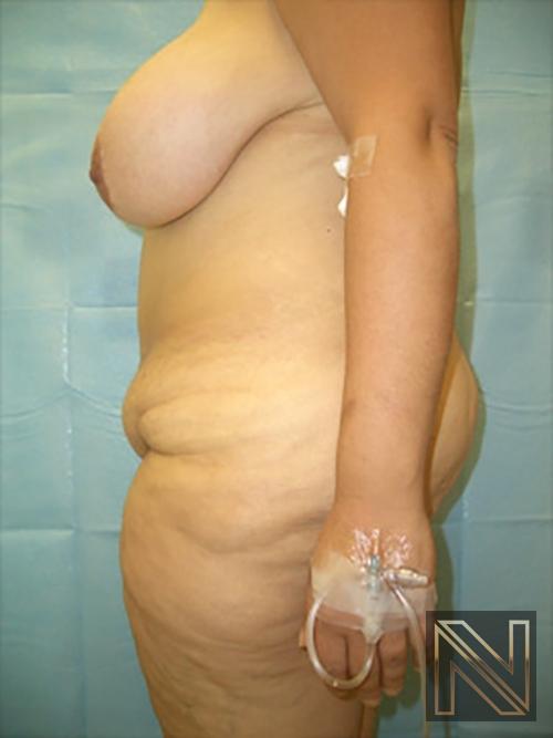 Abdominoplasty: Patient 19 - Before 2