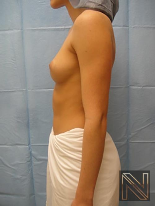 Breast Augmentation: Patient 6 - Before 4