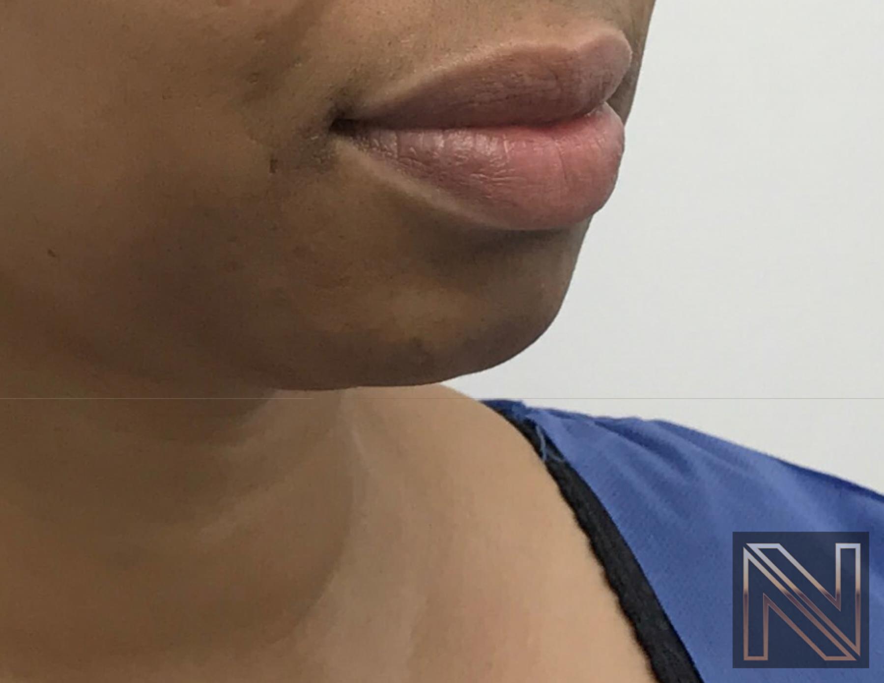 Chin Augmentation: Patient 3 - Before 1