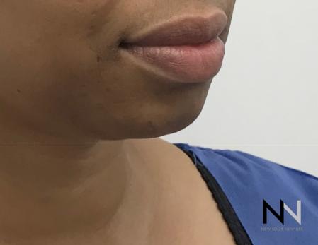 Chin Augmentation: Patient 3 - Before Image 1