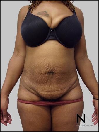 Mini Tummy Tuck: Patient 3 - Before Image 1