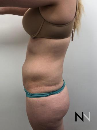 Liposuction: Patient 10 - Before and After Image 3
