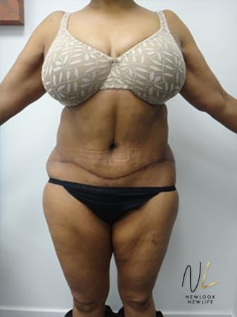 Abdominoplasty: Patient 8 - After Image 1