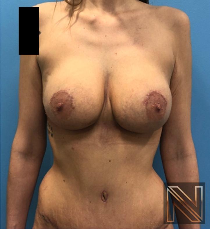 Breast Lift: Patient 18 - After 1
