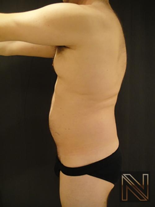 Liposuction: Patient 17 - Before 1