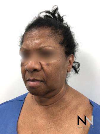 Facelift/Mini Facelift: Patient 7 - Before Image 3